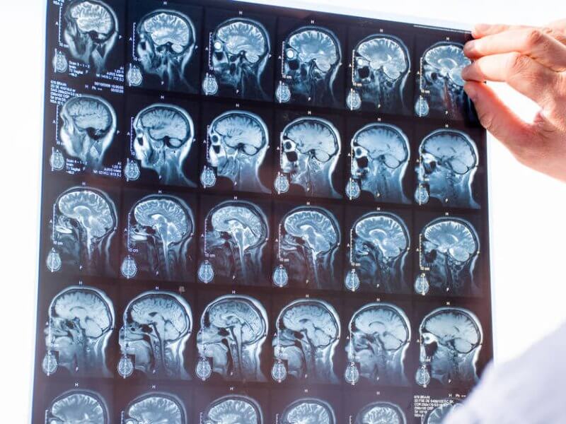 Modafinil for Traumatic Brain Injury