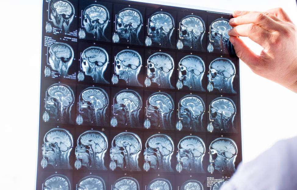 Modafinil for Traumatic Brain Injury